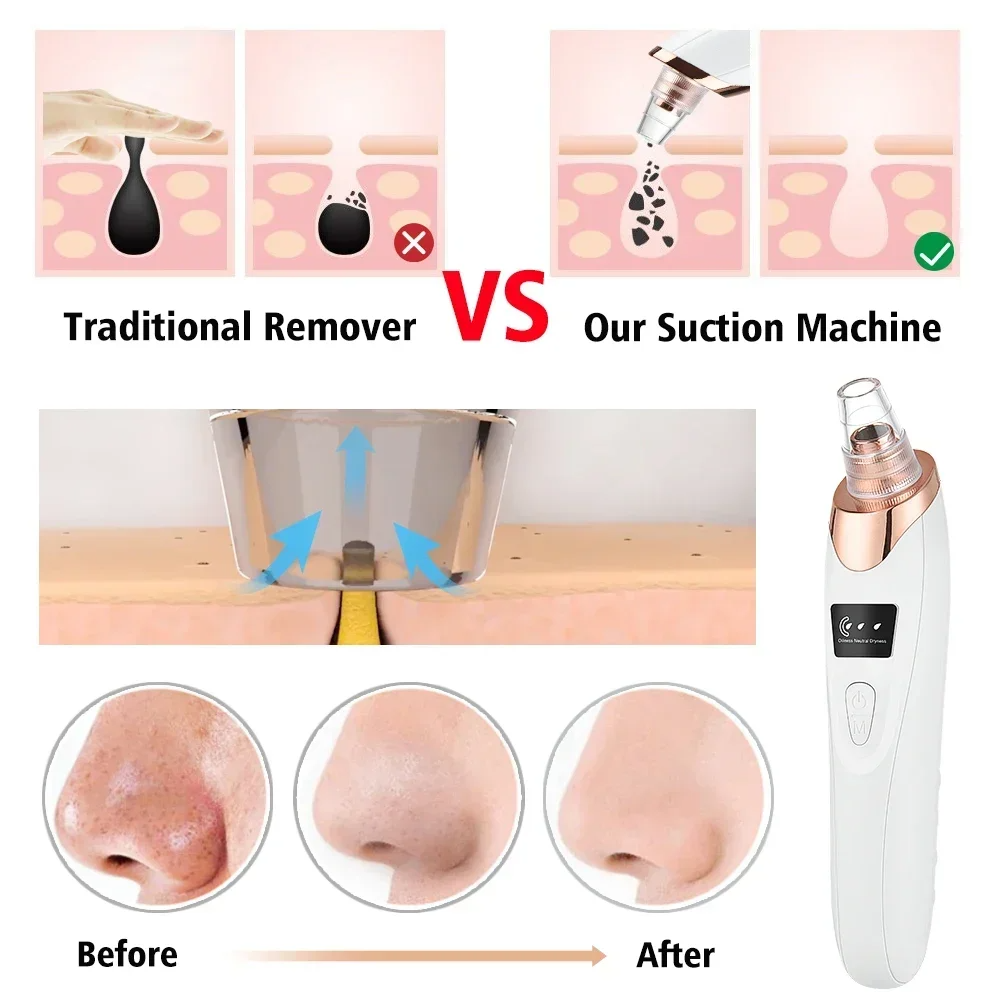 PoreRemover: Rechargeable Smart Blackheads, Whiteheads Pore Remover Kit