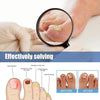 FungalPatch - Anti Bacterial Fungal Condition Patch And Nail Care Pack