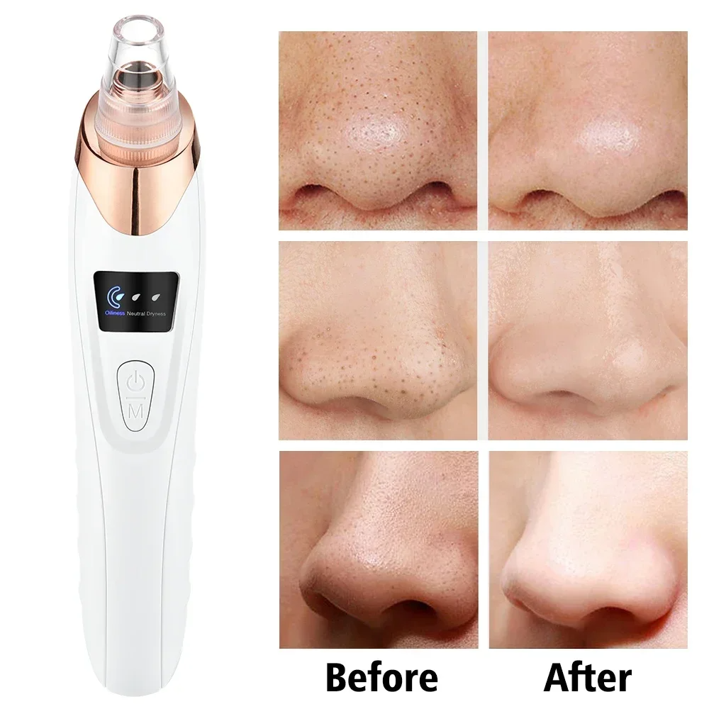PoreRemover: Rechargeable Smart Blackheads, Whiteheads Pore Remover Kit