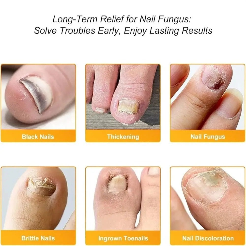FungalPatch - Anti Bacterial Fungal Condition Patch And Nail Care Pack